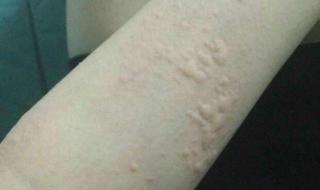 治疗慢性荨麻疹 治疗慢性荨麻疹